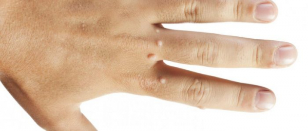 Бородавка на руке