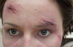 Бензилбензоат от прыщей Бензилбензоат от прыщей