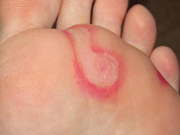 Подкожные бородавки Подкожные бородавки