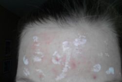 Бензилбензоат от прыщей Бензилбензоат от прыщей