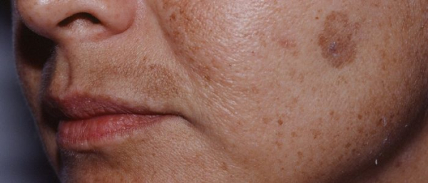 Пигментные пятна и солярий