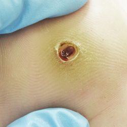 Подошвенные бородавки у детей Подошвенные бородавки у детей